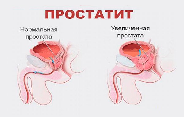 Uvelichennaya prostata