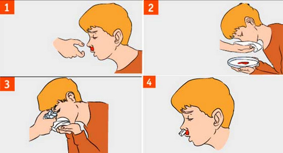 Первая помощи при кровотечении из носа